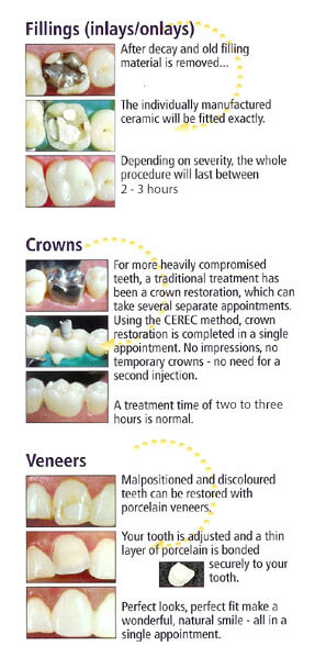 fillings crowns veneers