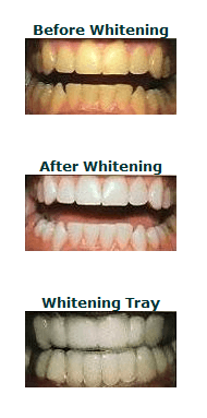 teeth-whitening